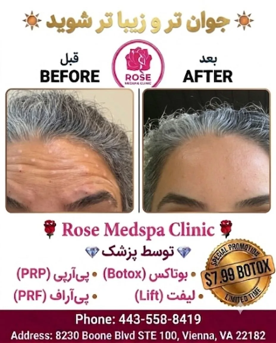 بوتاکس 7,99$